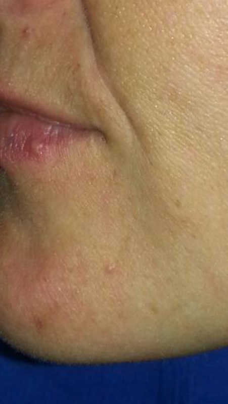 Finally A Cure For Perioral Dermatitis Perioral Dermatitis Cure
